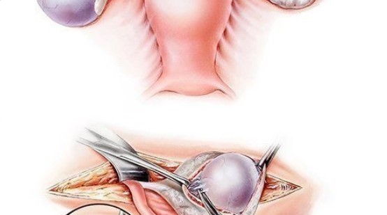 СИМПТОМЫ ПРИ КИСТЕ ЯИЧНИКА: